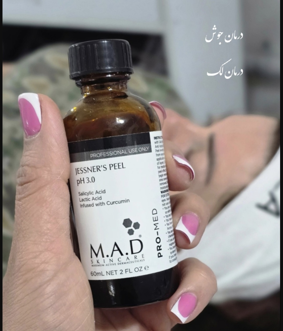 اسید جسنر ام ای دی   M.A.D Jessner Peel